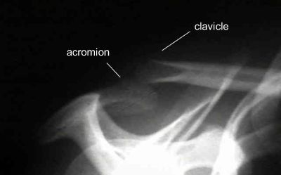 acromioclavicular joint