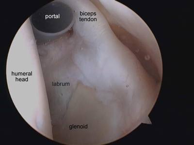 Arthroscopy