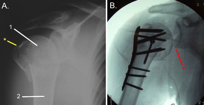 Part Prox Humerus Treatment