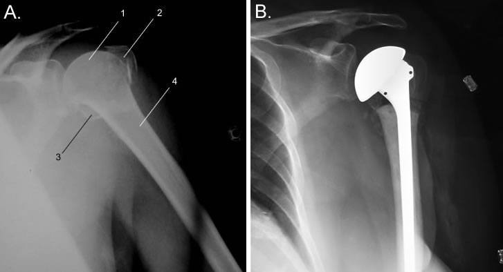 Parts Prox Humerus Treatment